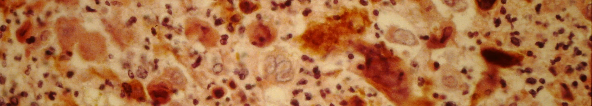 Episomal-Persistent DNA in Cancer and Chronic Diseases