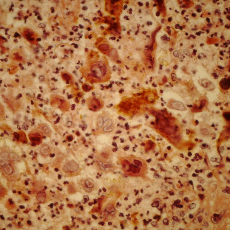 Episomal-Persistent DNA in Cancer and Chronic Diseases