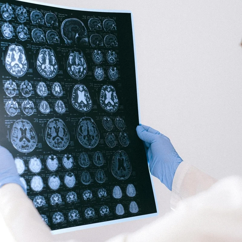 Role of ZBTB18 Tumor Suppression in Glioblastoma Progression