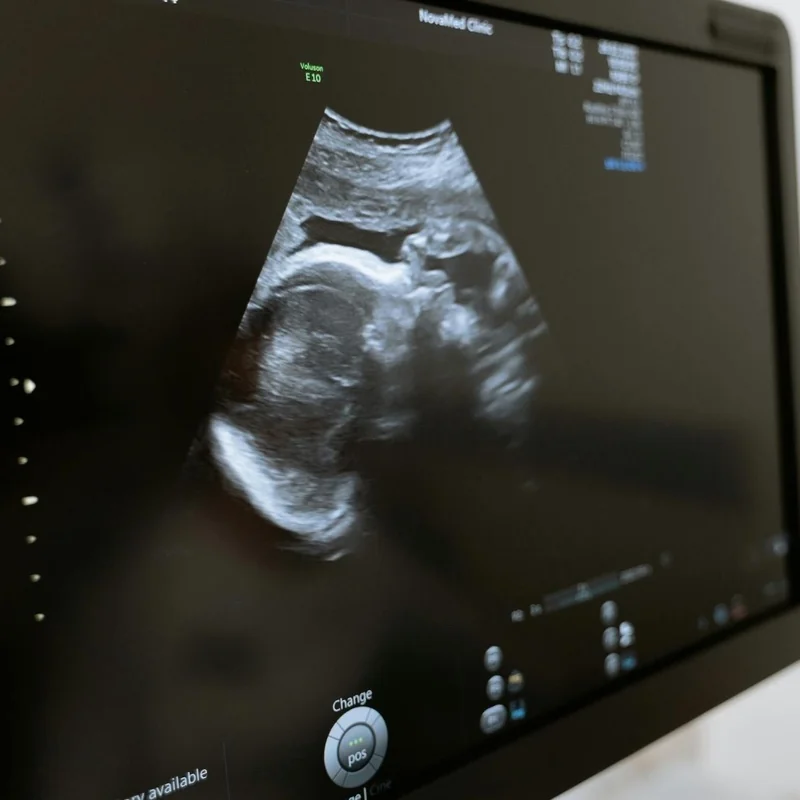 Dandy Walker Malformation Associated with Toxoplasmosis Infection in the Second Trimester: a Case Report