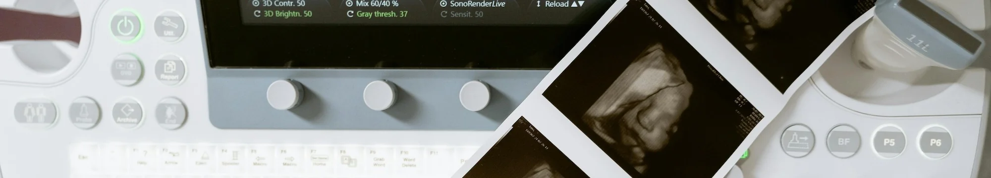 Kabuki Syndrome Diagnosed in utero: Clinical Case Reported in Santander, Colombia