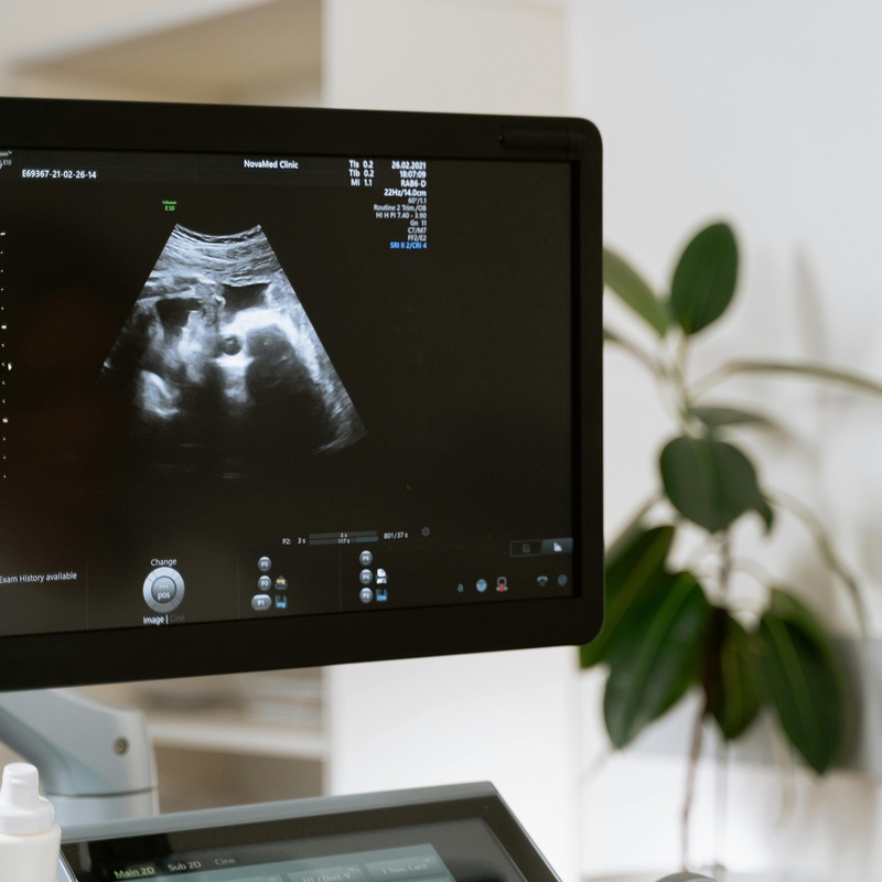 Significance of Timely Prenatal Care: A Case of Dandy-Walker Variant Diagnosed in the Third Trimester